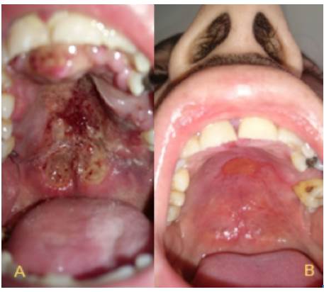 A. Initial lesion in the palate. B. 7 months after SMILE protocol chemotherapy.