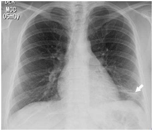 Posteroanterior chest X-ray. Image in left basal band corresponding to atelectasis (arrow).