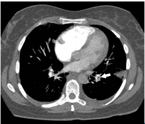 Angiotomography of the chest. Axial plane. Pulmonary embolism, filling defect in the shape of a life preserver sign (arrow).