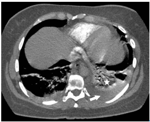 Chest AngioCAT. Broad base consolidation, hilar apex, obtuse borders that coincide with pulmonary infarction (star), pleural effusion (arrow).