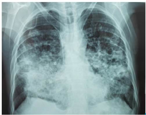 Chest x-ray with abundant alveolar opacities in both lung fields with formation of pneumatoceles.