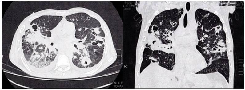 High-resolution computed tomography of the chest.