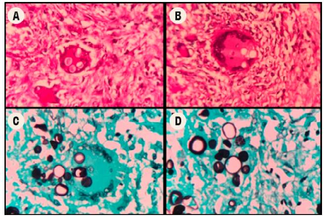 Lung histopathology. A and B: periodic acid-Schiff (PAS) staining; C and D: coloration with methenamine silver stain (GMS) corresponding to P. brasiliensis.