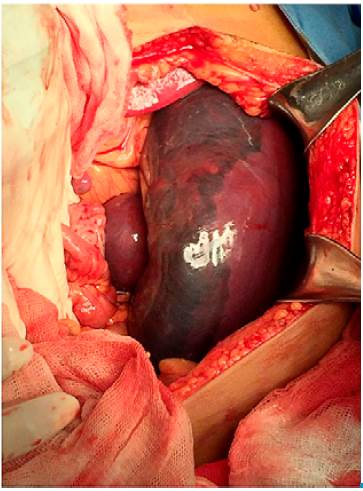 Subcapsular hematoma and splenic accessory lobe.