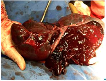 Splenic rupture.