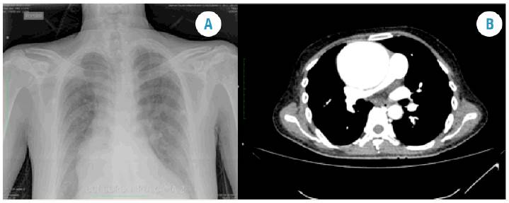 Posteroanterior chest radiograph. Grade 4 cardiomegaly and mediastinal widening at the expense of ascending aorta. Fig 1B. Computed tomography angiography: sagittal section. Aortic root of 90.2 mm, ascending aorta of 80.8 mm, insufficient tricuspid aortic valve and increased pulmonary systolic pressure (60 mmHg).