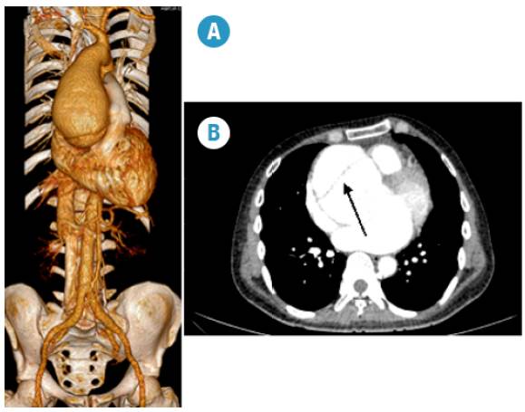 3D reconstruction of computed tomography angiography of the chest. Dilation of the ascending aorta. Aortic root 90.2 mm, anteroposterior diameter of ascending aorta of 80.8 mm. Fig 2B. Arrow. Intimal flap.