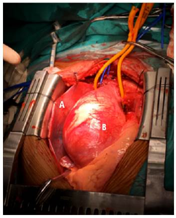Surgery. Exposure by median sternotomy. A. Pericardial sac. B. Aneurysmal ascending aorta.