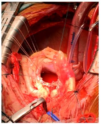 Exposure of the aortic ring with appropriate fixation points for subsequent placement of prosthetic 