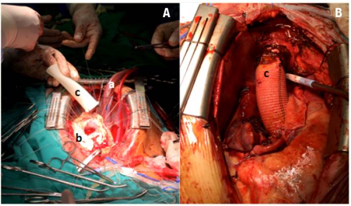 Exposure of the aortic ring with the appropriate fixation points after prosthesis placement. Fig 5b. Replacement of the aortic root using composite prosthesis and Bentall coronary reconstruction. a: extracorporeal circulation system. b: aortic ring with corresponding fixation points. c: prosthetic material.