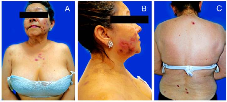 A. Front of the patient. The lesions can be observed in the cheeks, arms, and chest. B. profile of the patient portraying a close up of the cheek lesions. C. Back of the patient showing the extent of the lesions.