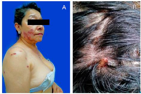 A. profile of the patient showing the lesions on both cheeks B. picture showing some of the multiple lesions on the scalp.