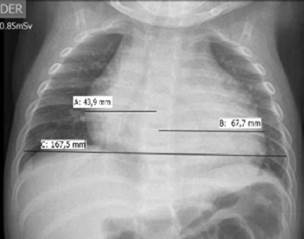Initial chest x-ray.