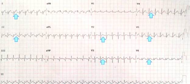 Evidence of electrocardiographic changes in the patient.