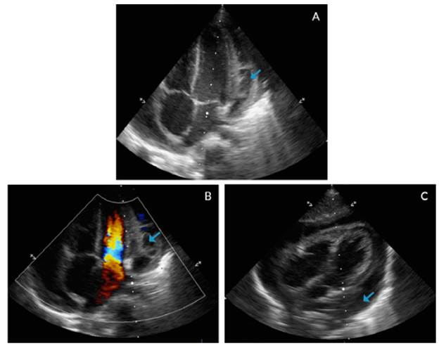 Echocardiogram with apical four chamber view (A, B) and coronal axial plane (C).