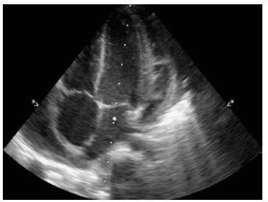 Echocardiogram taken before discharge.