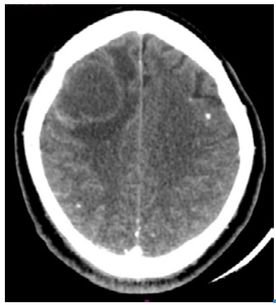 Computed tomography with right frontal subcortical cystic lesion, perilesional edema and calcified nodules.