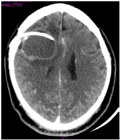 Computed tomography with right frontal subcortical cystic lesion, midline shift and ventriculoperitoneal shunt.