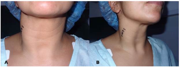 Deformity of the right contour of the neck. A) Anterior aspect of the neck; B) Lateral aspect of the neck.