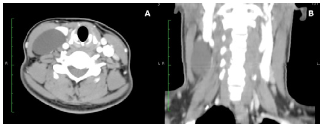 Contrast computed tomography of the neck. A) Thin-walled cyst medial to the sternocleidomastoid muscle; B) Cystic lesion occupying the right III and IV levels.