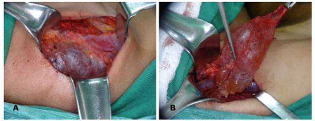 Intraoperative appearance. A) Transverse incision of the neck. A deep lesion of the sternocleidomastoid muscle was observed along with junctions to the internal jugular vein and accessory nerve. B) Lymphangioma was dissected from the internal jugular vein.