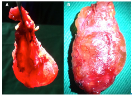 Surgical specimen: transillumination revealed a thin-walled cyst.