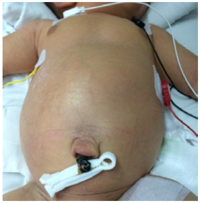 Severe abdominal distension before surgery.