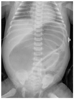 Significant colon distension.