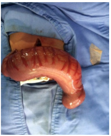 3A. Colon atresia type III.