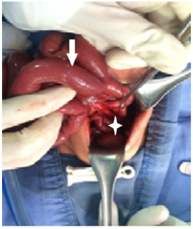 3B. Evidence of difference in approximate distal 10-1 caliber. (*) Distal, (Arrow) Proximal.