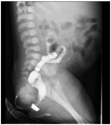 Hypoplasia of distal colon.