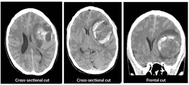 Simple computerized axial tomography of the brain prior to surgery.
