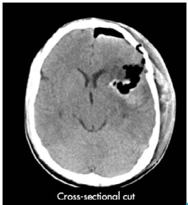 Simple computed tomography of the brain after surgery.