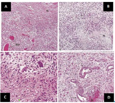 Histopathological findings. A) high cellularity, abundant blood vessels and wide necrotic areas; B) prominent cellularity around a vessel and pseudoempalized cellularity around a necrotic area; C) variation in size and shape of the nuclei, some are markedly enlarged; D) small and medium blood vessels with thick walls that tend to bleed and endothelial cell proliferation.