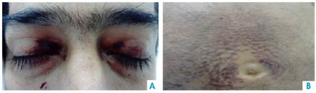 A. Periorbital ecchymosis. B. Perimumbilical purpuric macules.