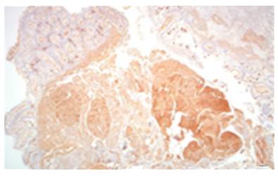 Colon biopsy, aspirated bone marrow. 40x lens with plasmocytes, some atypical binucleate cells, eccentric nucleus, broad and basophilic cytoplasm.