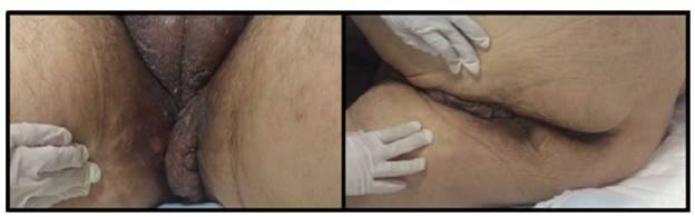 Hyperpigmentation and perineal tumor, and scrotal infiltration.