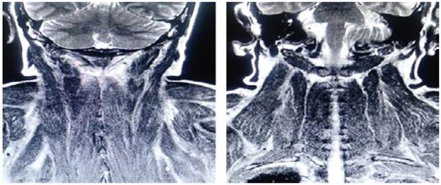 Contrast-enhanced MRI of the head and neck, coronal plane, with paraspinal muscular edema.