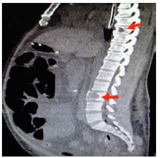 Sagittal CT scan of contralateral abdomen: distended loops and lytic lesions in T8 and L3 (arrows).