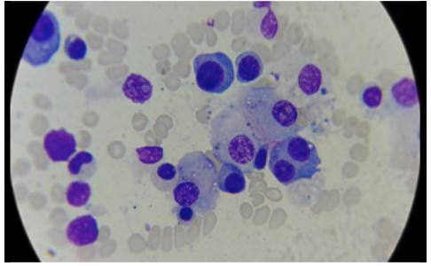 Bone marrow aspirate, 40x lens with plasmocytes, some atypical binucleated cells, eccentric nucleus, broad and basophilic cytoplasm.