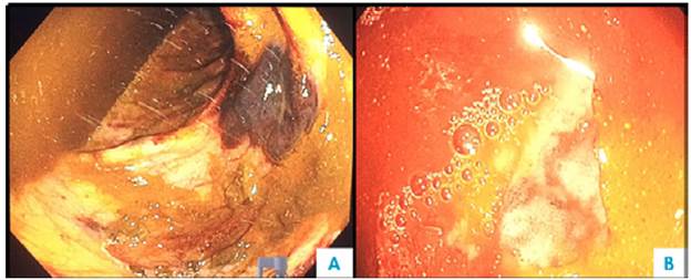 Colonoscopy. A) Submucosal hematoma and multiple mucosal ecchymoses; B) congestive mucosa and ulcer covered by fibrin.