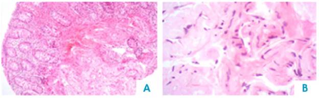 Colon, submucosa and vessel wall biopsy with amorphous eosinophilic material deposit, using hematoxylin and eosin stain. A) 4x lens; B) 40x lens.