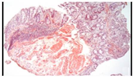 Colon biopsy, Congo red staining with salmon-colored deposits in the thickened wall of the vessels. 4x lens.