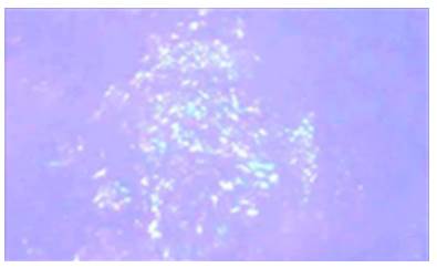 Colon biopsy, Congo Red staining. Apple-green birefringence on the wall of the glasses under polarized light with 40x lens.