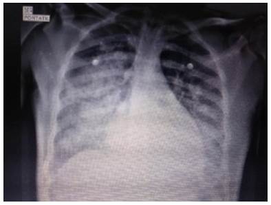 Chest x-ray.