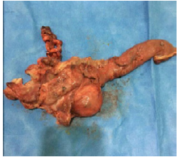 Surgical piece removed -mass involving the duodenum, the bowel, the gallbladder, and the lower part of the liver.