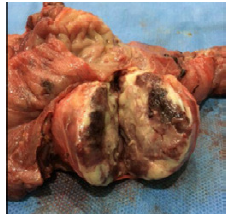 Surgical piece removed: mass in the head of the pancreas with hemorrhagic foci at cut.