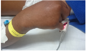 Primary site of contact with caterpillar Lonomia sp.