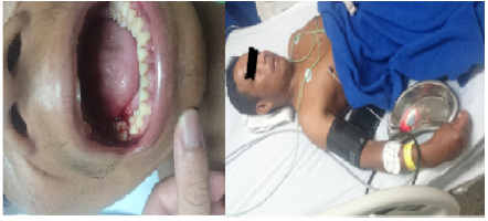 Bleeding of the gums.