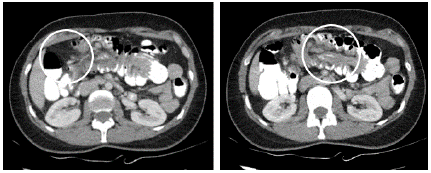 CT scan of the abdomen performed on admission showing colo-colonic intussusception.